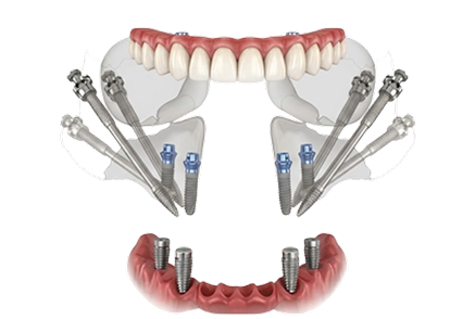 implant images