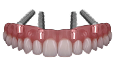 All on 4 Dental Implants
