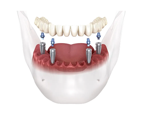 implant images