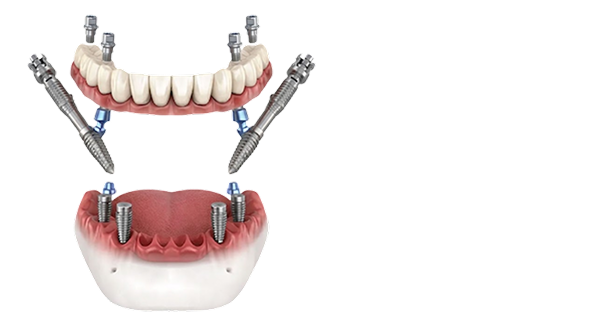 implant images