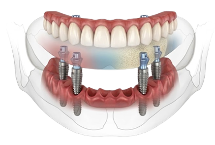 implant images