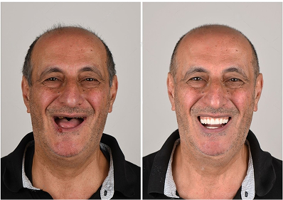 Smile transformation one